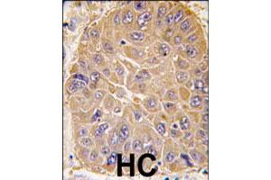 Formalin-fixed and paraffin-embedded human hepatocellular carcinoma reacted with ALDH5A1 polyclonal antibody  , which was peroxidase-conjugated to the secondary antibody, followed by DAB staining. (ALDH5A1 anticorps  (N-Term))