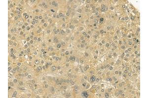ABIN6258723 and ABIN6274903 at 1/100 staining human hepatocellular carcinoma by IHC-P. (GCNT7 anticorps  (Internal Region))