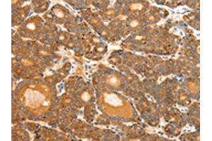 The image on the left is immunohistochemistry of paraffin-embedded Human thyroid cancer tissue using ABIN7192287(SCT Antibody) at dilution 1/40, on the right is treated with synthetic peptide. (Secretin anticorps)