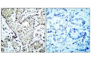 Immunohistochemical analysis of paraffin-embedded human breast carcinoma tissue, using MKK6 (Ab-207) antibody (E021153). (MAP2K6 anticorps)