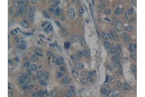 Detection of MYH10 in Human Breast cancer Tissue using Polyclonal Antibody to Myosin Heavy Chain 10, Non Muscle (MYH10)