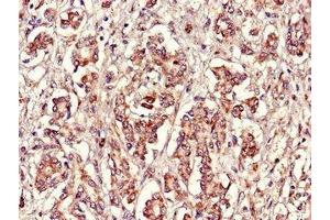 Immunohistochemistry of paraffin-embedded human pancreatic cancer using ABIN7152398 at dilution of 1:100