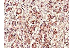 Immunohistochemistry of paraffin-embedded human pancreatic cancer using ABIN7152398 at dilution of 1:100 (FBXL22 anticorps  (AA 123-229))