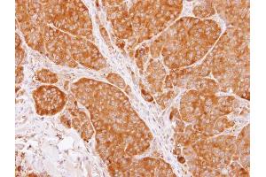 IHC-P Image Immunohistochemical analysis of paraffin-embedded SW480 xenograft, using TCP1 beta, antibody at 1:100 dilution.