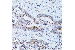 Immunohistochemistry of paraffin-embedded human colon carcinoma using GIP antibody (ABIN5973668) at dilution of 1/100 (40x lens). (GIP anticorps)