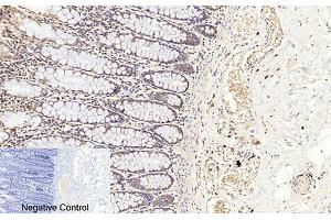 Immunohistochemical analysis of paraffin-embedded human colon tissue. (Caspase 3 p17 (AA 100-180), (Cleaved-Asp175) anticorps)