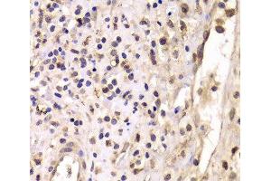 Immunohistochemistry of paraffin-embedded Human breast cancer using HDAC4 Polyclonal Antibody at dilution of 1:100 (40x lens).