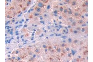 Detection of IL10Ra in Human Liver cancer Tissue using Polyclonal Antibody to Interleukin 10 Receptor Alpha (IL10Ra) (IL-10RA anticorps  (AA 132-235))