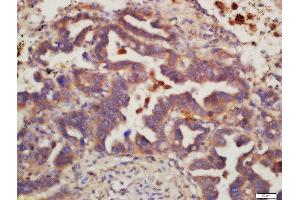 Formalin-fixed and paraffin embedded human lung carcinoma labeled with Rabbit Anti-MSH6 Polyclonal Antibody, Unconjugated 1:200 followed by conjugation to the secondary antibody and DAB staining (MSH6 anticorps  (AA 812-910))
