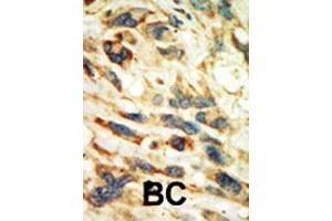 Formalin-fixed and paraffin-embedded human cancer tissue reacted with the primary antibody, which was peroxidase-conjugated to the secondary antibody, followed by AEC staining.