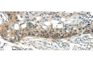 Immunohistochemistry of paraffin-embedded Human esophagus cancer tissue using WNT6 Polyclonal Antibody at dilution 1:35 (WNT6 anticorps)