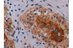 Detection of ErbB2 in Human Breast Cancer Tissue using Polyclonal Antibody to Receptor Tyrosine Protein Kinase erbB-2 (ErbB2) (ErbB2/Her2 anticorps  (AA 23-372))