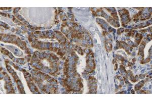ABIN6267163 at 1/100 staining Human thyroid cancer tissue by IHC-P. (DLG2 anticorps  (pTyr340))