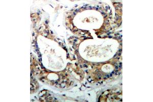 Immunohistochemistry of paraffin-embedded human breast carcinoma using Phospho-PTPN11-Y542 antibody (ABIN2987776). (PTPN11 anticorps  (pTyr542))