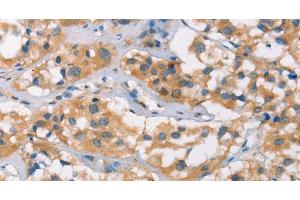 Immunohistochemistry of paraffin-embedded Human thyroid cancer tissue using DSC2 Polyclonal Antibody at dilution 1:35