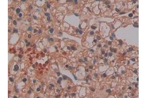 Detection of PR3 in Human Renal cancer Tissue using Polyclonal Antibody to Proteinase 3 (PR3)