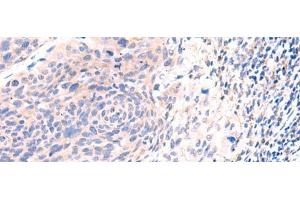 Immunohistochemistry of paraffin-embedded Human cervical cancer tissue using ESM1 Polyclonal Antibody at dilution of 1:50(x200) (ESM1 anticorps)