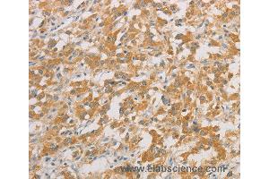 Immunohistochemistry of Human colon cancer using ZWINT Polyclonal Antibody at dilution of 1:50 (ZWINT anticorps)