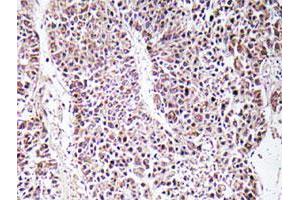 Immunohistochemical analysis of paraffin-embedded human liver carcinoma tissue using GDF9 polyclonal antibody . (GDF9 anticorps)