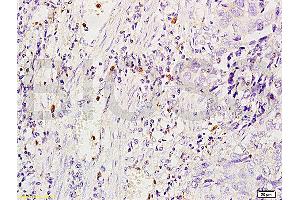 Formalin-fixed and human glioma tissue labeled with Anti-MSR1/CD204 Polyclonal Antibody, Unconjugated (ABIN872905) at 1:200 followed by conjugation to the secondary antibody and DAB staining (Macrophage Scavenger Receptor 1 anticorps  (AA 211-320))