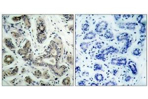 Immunohistochemical analysis of paraffin-embedded human breast carcinoma tissue using BAD(Phospho-Ser136) Antibody(left) or the same antibody preincubated with blocking peptide(right).