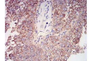 Immunohistochemical analysis of paraffin-embedded endometrial cancer tissues using AKT1 mouse mAb with DAB staining.