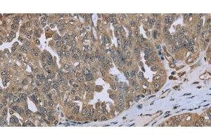 Immunohistochemistry of paraffin-embedded Human ovarian cancer tissue using DCTN4 Polyclonal Antibody at dilution 1:50 (Dynactin 4 anticorps)