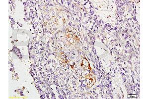 Formalin-fixed and paraffin embedded human esophageal carcinoma labeled with Anti-RAB8 Polyclonal Antibody, Unconjugated (ABIN715316) at 1:200, followed by conjugation to the secondary antibody and DAB staining (RAB8A anticorps  (AA 101-207))