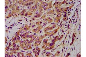 IHC image of ABIN7157412 diluted at 1:400 and staining in paraffin-embedded human liver cancer performed on a Leica BondTM system. (Cytokeratin 1 anticorps  (AA 267-438))