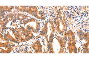 Immunohistochemistry of paraffin-embedded Human gasrtic cancer tissue using AK5 Polyclonal Antibody at dilution 1:60 (Adenylate Kinase 5 anticorps)