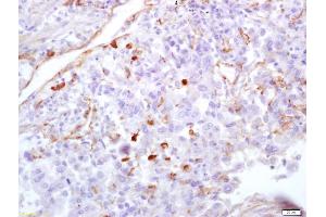 Formalin-fixed and paraffin embedded human lung carcinoma labeled with Anti CCL3/MIP 1?