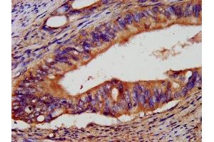 IHC image of ABIN7151921 diluted at 1:400 and staining in paraffin-embedded human colon cancer performed on a Leica BondTM system.
