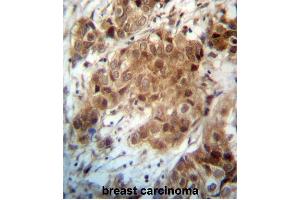 FOXO3 Antibody (N-term) (ABIN657229 and ABIN2846331) immunohistochemistry analysis in formalin fixed and paraffin embedded human breast carcinoma followed by peroxidase conjugation of the secondary antibody and DAB staining. (FOXO3 anticorps  (N-Term))
