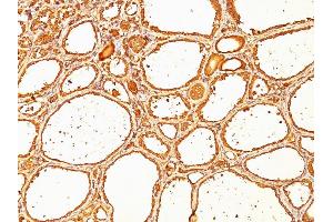 Formalin-fixed, paraffin-embedded human Thyroid Carcinoma stained with Thyroglobulin Monoclonal Antibody (SPM517).
