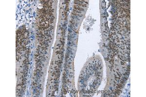 Immunohistochemistry of Human colon cancer using MCM6 Polyclonal Antibody at dilution of 1:60 (MCM6 anticorps)