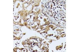 Immunohistochemistry of paraffin-embedded human lung cancer using D antibody (ABIN7266712) at dilution of 1:100 (40x lens). (DAPK3 anticorps  (AA 1-100))