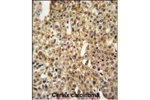 DEN1A Antibody (C-term) (ABIN653873 and ABIN2843124) IHC analysis in formalin fixed and paraffin embedded human cervix carcinoma followed by peroxidase conjugation of the secondary antibody and DAB staining. (DENND1A anticorps  (C-Term))