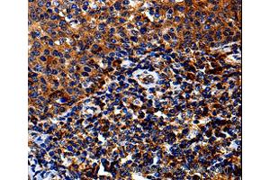 Immunohistochemistry of Human lung cancer using IL13RA1 Polyclonal Antibody at dilution of 1:50 (IL13 Receptor alpha 1 anticorps)