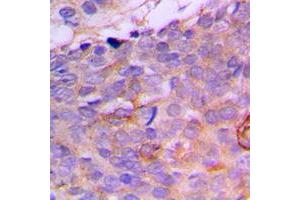 Immunohistochemical analysis of CRABP2 staining in human breast cancer formalin fixed paraffin embedded tissue section.