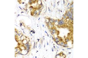 Immunohistochemistry of paraffin-embedded human liver cancer using TOMM20 antibody.