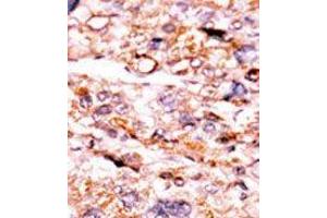 Formalin-fixed and paraffin-embedded human cancer tissue reacted with the primary antibody, which was peroxidase-conjugated to the secondary antibody, followed by AEC staining.