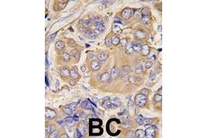 Formalin-fixed and paraffin-embedded human breast carcinoma tissue reacted with HSPB1 Antibody (S78) (ABIN391298 and ABIN2841334) , which was peroxidase-conjugated to the secondary antibody, followed by DAB staining. (HSP27 anticorps  (AA 56-85))