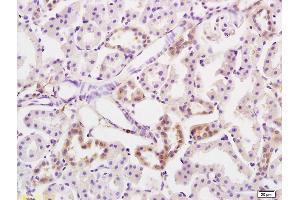 Formalin-fixed and paraffin embedded human colon carcinoma labeled with Anti-PRKD3 Polyclonal Antibody, Unconjugated (ABIN754678) at 1:200 followed by conjugation to the secondary antibody and DAB staining (PRKD3 anticorps  (AA 345-550))