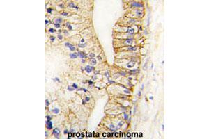 Formalin-fixed and paraffin-embedded human prostate carcinomareacted with CDH7 polyclonal antibody , which was peroxidase-conjugated to the secondary antibody, followed by AEC staining. (Cadherin 7 anticorps  (N-Term))