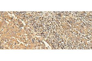 Immunohistochemistry of paraffin-embedded Human cervical cancer tissue using RPS28 Polyclonal Antibody at dilution of 1:30(x200)