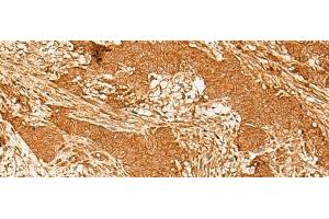 Immunohistochemistry of paraffin-embedded Human ovarian cancer tissue using GTF3C3 Polyclonal Antibody at dilution of 1:30(x200) (GTF3C3 anticorps)