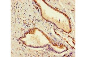 Immunohistochemistry of paraffin-embedded human prostate cancer using ABIN7177995 at dilution of 1:100 (ADCK2 anticorps  (AA 200-609))