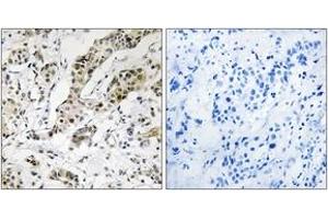 Immunohistochemistry analysis of paraffin-embedded human breast carcinoma, using TCEAL3/5/6 Antibody. (TCEAL3/5/6 anticorps  (AA 141-190))