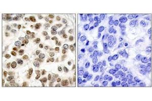 Immunohistochemical analysis of paraffin-embedded human breast carcinoma tissue, using BRCA1 (Ab-1423) antibody (E021234). (BRCA1 anticorps)