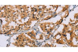 Immunohistochemistry of paraffin-embedded Human thyroid cancer tissue using NRN1 Polyclonal Antibody at dilution of 1:50 (NRN1 anticorps)